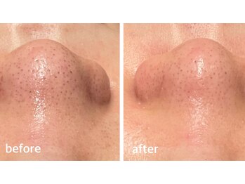 ベベ 金沢本店(Be'be')/お肌変化.1