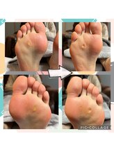 Dr.ネイル爪革命 静岡沼津店/うおのめケア