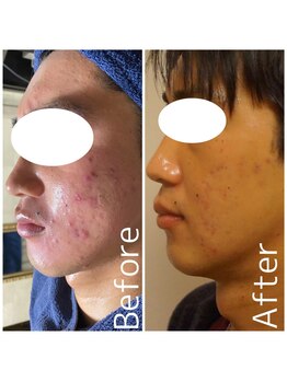 トータルメンズエステ キング(KING)/自宅でのケア方法も伝授