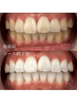 グロウ 東区香椎(GLOW)/本格ホワイトニング