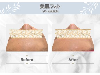 シャンディール(shandeel)/光フェイシャル