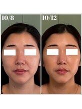 グロウズ(Glows)/W高周波