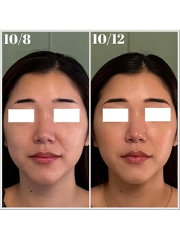 グロウズ(Glows)/W高周波