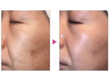 フルール/マイクロニードルピーリング