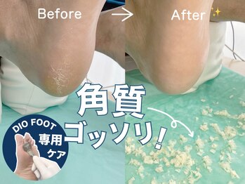 ディオフット(DIO FOOT)の写真/【足裏の角質を徹底除去！】ガサガサかかと,魚の目,タコ...フットケアでお悩み解消♪
