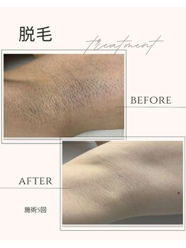 レクラ(L‘ECLAT)/メンズもおすすめ!ワキ脱毛1回