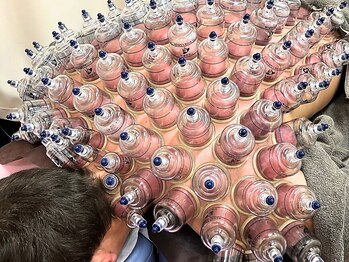 仁接骨院 じん鍼灸治療院/カッピング+鍼灸