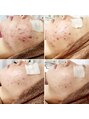 アナシアビューティーサロン(Anacia) ビフォーアフター
