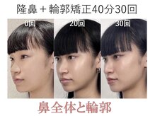 ラプリ 梅田店(Raplit)/隆鼻＋輪郭矯正40分30回