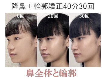 ラプリ 梅田店(Raplit)/隆鼻＋輪郭矯正40分30回