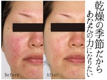 スポット 薬院駅前店(SPOT)の雰囲気（#乾燥肌 #ニキビケア #赤ら顔 #毛穴詰まり #毛穴黒ずみ #くすみ）