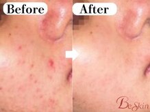 ビースキン 広島(BE:SKIN)/ハーブピーリング/ニキビケア