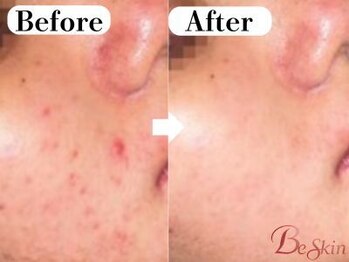 ビースキン 広島(BE:SKIN)/ハーブピーリング/ニキビケア
