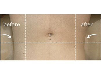 小顔・痩身専門店Lift(リフト)練馬/小顔専門店Lift|Before After