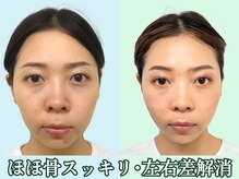 ナチュラルパーフェクトフェイス 新宿/歪みを整えた顔／渋谷区小顔