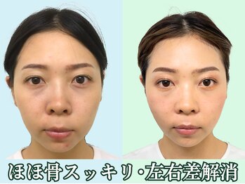 ナチュラルパーフェクトフェイス 新宿/歪みを整えた顔／渋谷区小顔