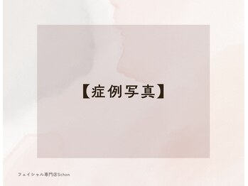 シェーン(Schon)/Before→Afterのお写真