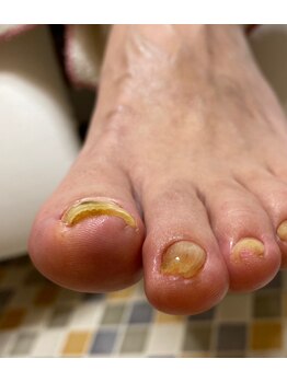 巻き爪矯正　ツメフラ法