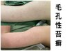 【剥離◎二の腕】毛孔性苔癬やニキビケアに効果有○/ハーブピーリング¥33000