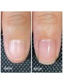 アミカ ネイル(amica nail)&nbsp;最強ネイルケアコース♪3ヶ月間育成でお悩みを解消します！
