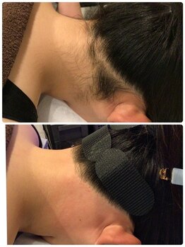 ビープラス(B plus)/うなじWAX脱毛で理想のうなじへ