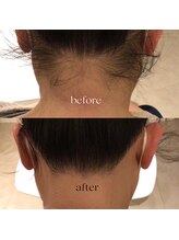 カルーナ 住吉店/えりあし脱毛