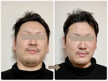 哲心 姫路/顎周りのむくみが取れました！
