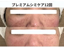 プレジール(plaisir)/シミケアコース
