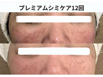 プレジール(plaisir)/シミケアコース
