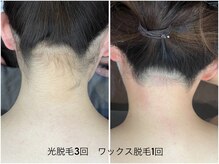 レイズ(RAISE)/うなじ脱毛