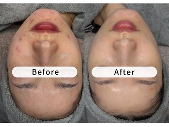 エミエル(EMIER)/ハーブピーリングBefore→After