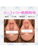【迷ったらこのクーポンで予約！】大人気★顔脱毛×フェイシャル（洗浄/ピーリング/美白導入/パック）