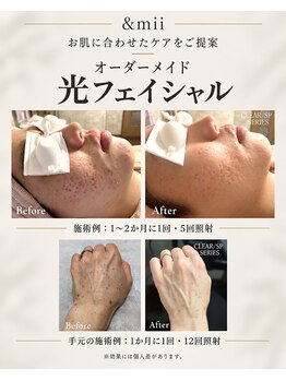 アンドミー(&mii)の写真/月1回のお手入れで卵肌へ♪オーダーメイド光フェイシャル、潤艶WAXなどお悩み別にご提案します！