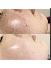 アルページュ(Arpege)/美肌の極み★リアボーテハーブ3g