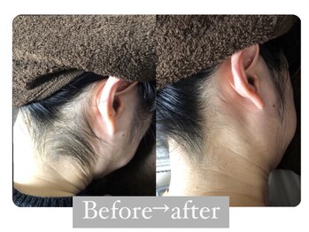 レミーラ(Remira)/リピーター続出！！うなじ脱毛