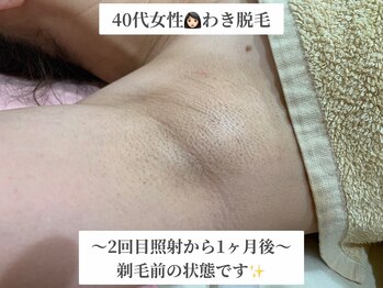 ポノ(Pono)/わき脱毛