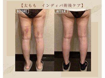 オキシー グレイス 黒崎店(OXY Grace)/太もも術後インディバ