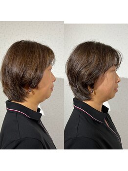 リープラス 赤坂(Re-plus)/美容鍼《リフトアップ・たるみ》