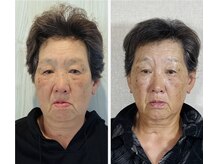 真美(Sinbi)/リターンフェイシャル施術2回