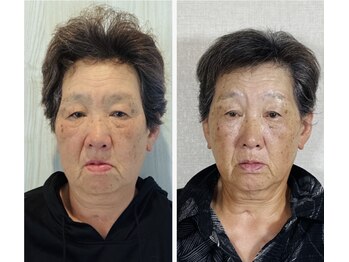 真美(Sinbi)/リターンフェイシャル施術2回