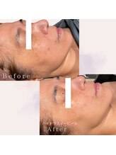 アルバ 広島店(ALBA)/【エイジング】スノーピーリング