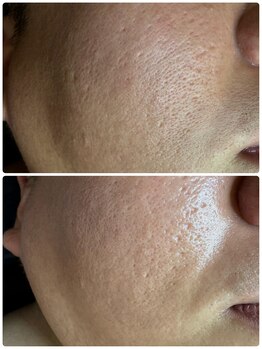 ゼニス 池袋本店(ZENITH)/気にしてる?メンズも肌管理時代!