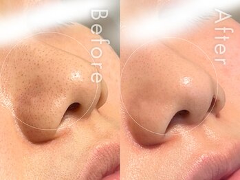 セルフミー 恵比寿(SELF Me...)/ハーブピーリング/毛穴改善