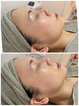 ケイサロン 朝霞店(K salon)/光フェイシャル×炭酸パック