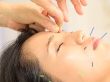 ハリ ヴァカンス(Hari Vacances)/お悩みに合わせた美容鍼ができる