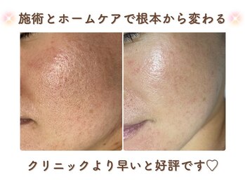 ミサズ スキンケア(misa's skin care)の写真/1回でも変化を実感。3回ほどでノーファンデへ!透明感・肌触り・キメ細やかさまで叶える本格美肌毛穴ケア