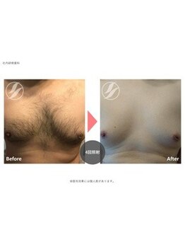 ダイアナ 出雲店(Daiana)/胸毛とバストケア