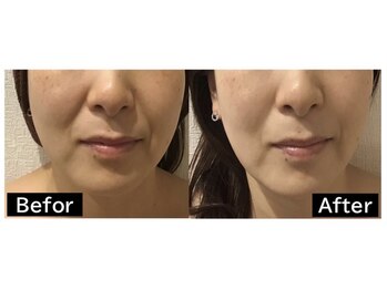 リラ(RILA)/ハーブピーリングbefore after