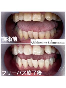 ホワイトニングサロン 京都烏丸店/ホワイトニング施術例