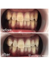 ホワイトニングカフェ 岸和田店(WhiteningCafe)/プレミアム10回照射後